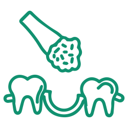 Bone Grafting Surgery-01